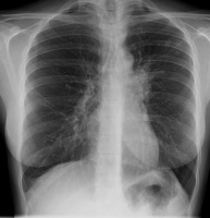 imagine cu tuberculoza pulmonara